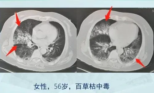 男子喝下百草枯后肺部轻微纤维化，长期影响及应对之道