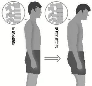 部队新规下强直性脊柱炎的挑战及应对策略